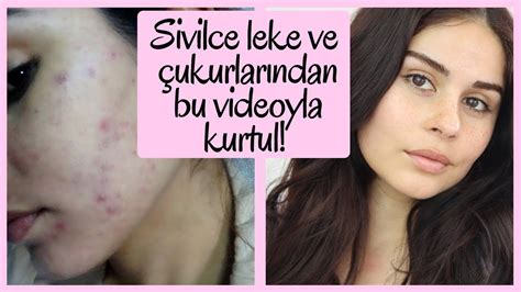 Ciltteki Sivilce İzleri İçin Evde Uygulanabilecek Tarifler